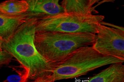 photograph of cancer cells under microscope